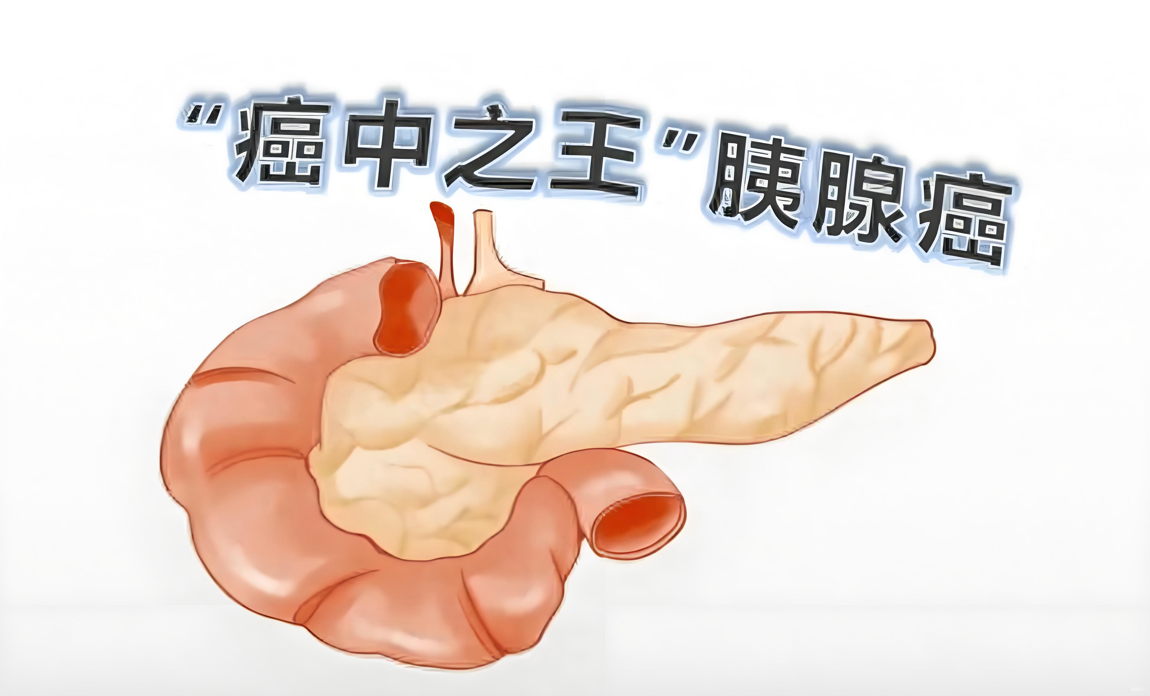 胰腺有癌，吃饭知道？吃饭时出现的5个表现，或是胰腺癌来临！