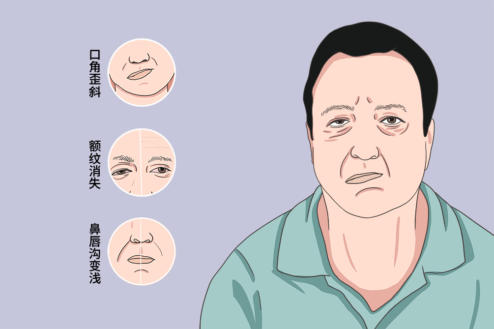 面瘫就医指南｜手把手教学，助你早日康复！