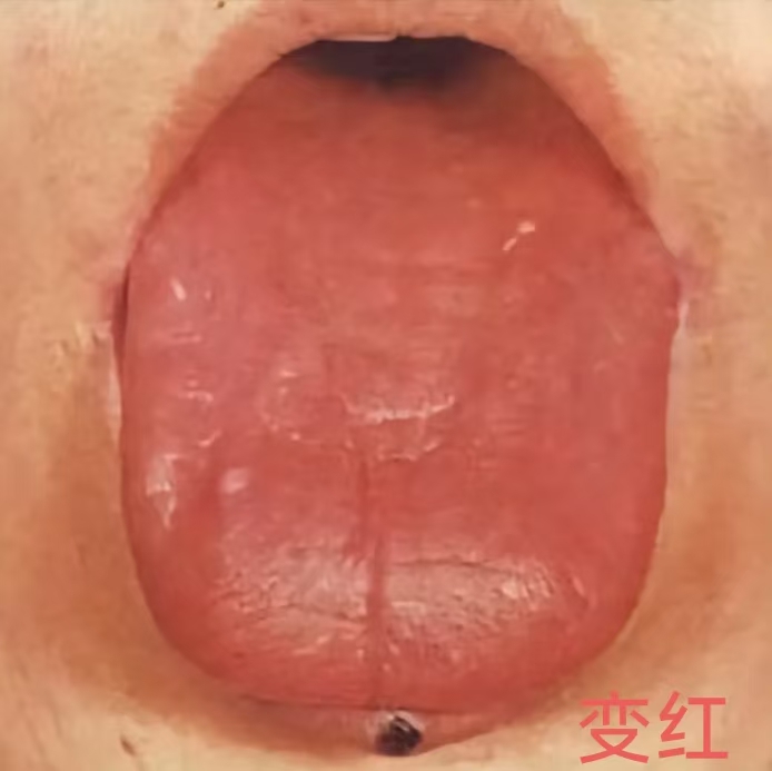 不知道病情走势？看舌头就知道了