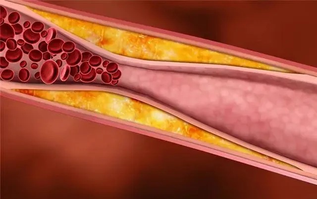 血管堵塞的4个信号！清除血管垃圾，应该怎么做？