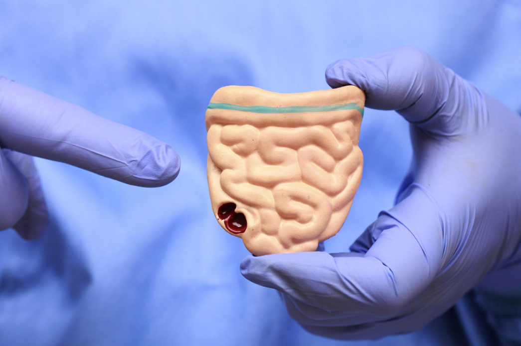 人不会无缘无故患直肠癌！研究发现：得直肠癌，离不开这5点！