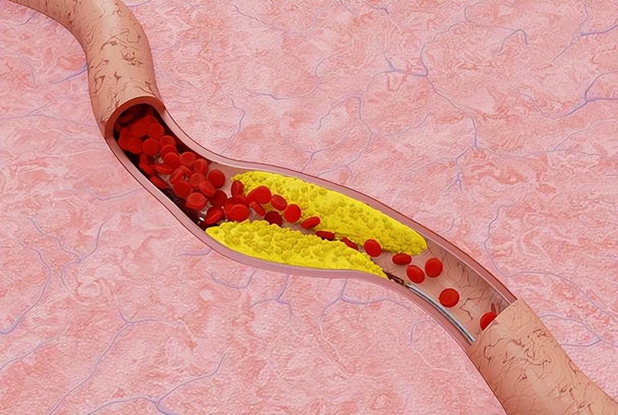 血管最怕的隐形杀手，不是肉也不是油，这3类你可能天天吃