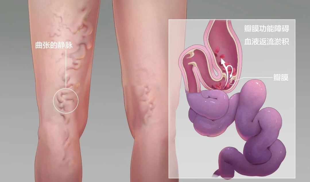 不可大意！下肢静脉曲张，不仅仅是影响美观！
