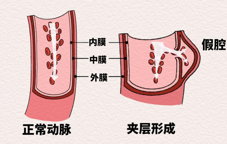 他差点因一次晨练猝死！医生提醒：降温后，这类病进入高发期