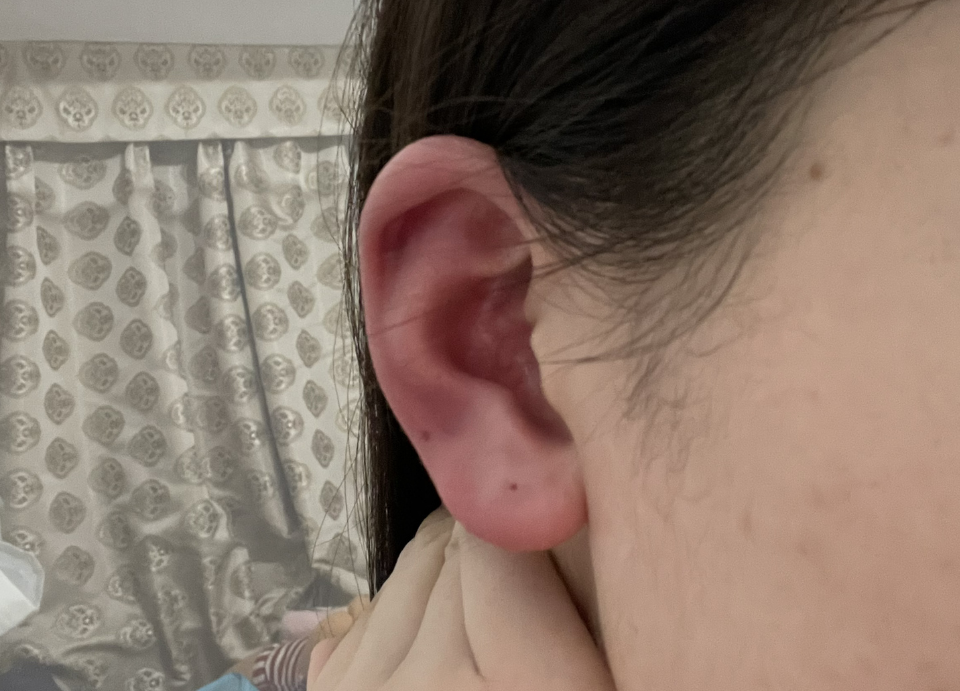 耳朵发红别忽视！3个隐藏因素，第三个多数人中招！