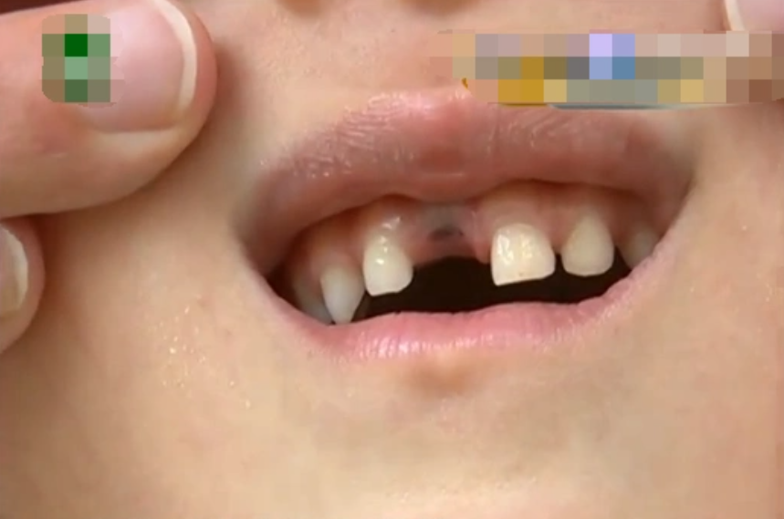 牢记！关键时刻，能救“牙”一命！口腔急诊医生紧急提示！