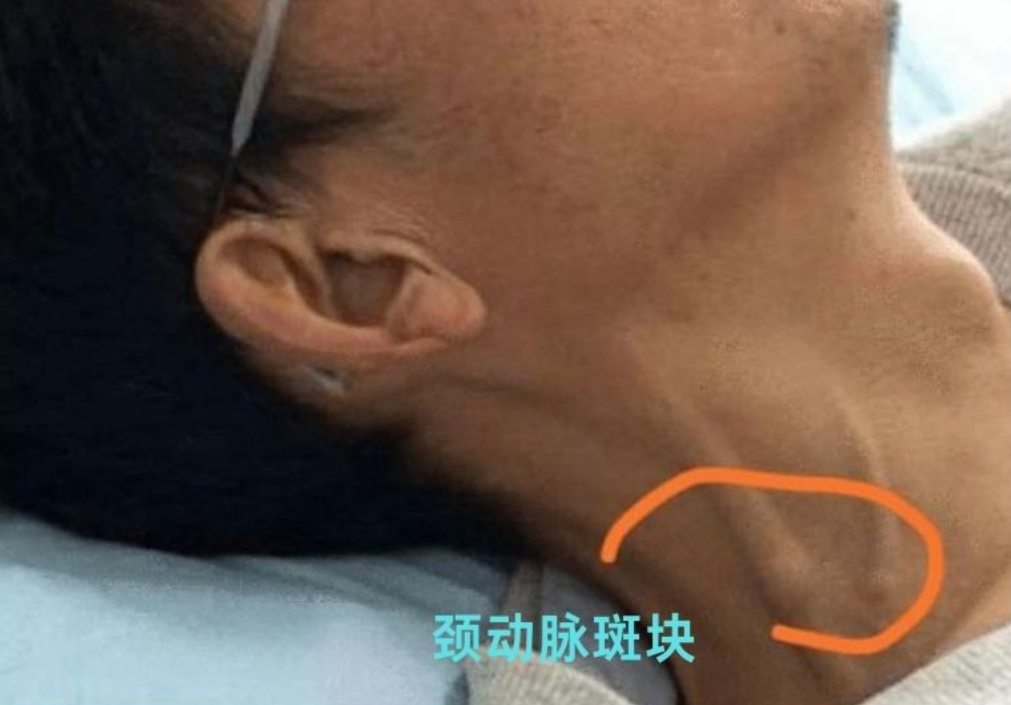 63岁大爷一年后血管斑块消失！养成6个习惯，斑块或可逐渐消散！