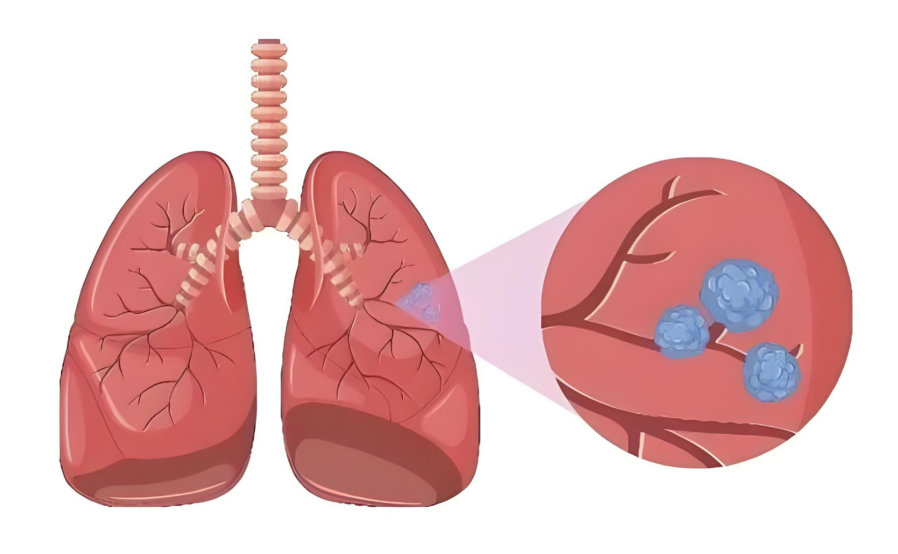 人不会无缘无故长结节！医生：若能改掉5个坏习惯，或可避免！