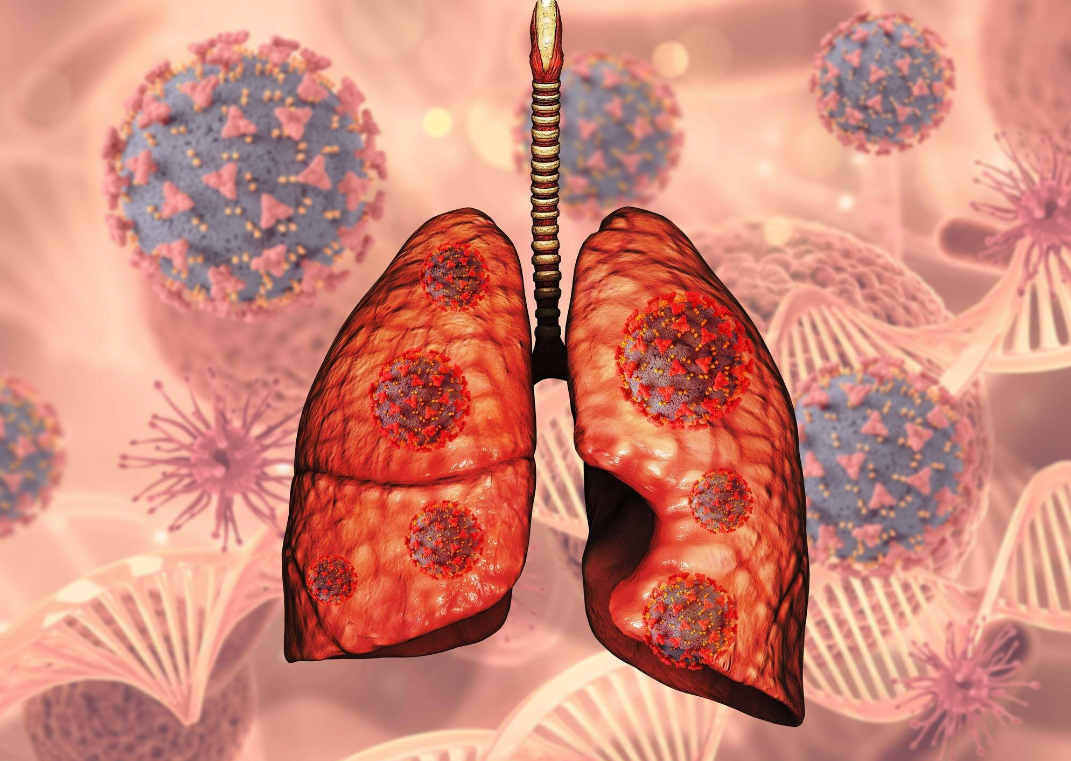 肺病提前一年就有征兆？医生调查提醒：身体这几处变化不要忽视！