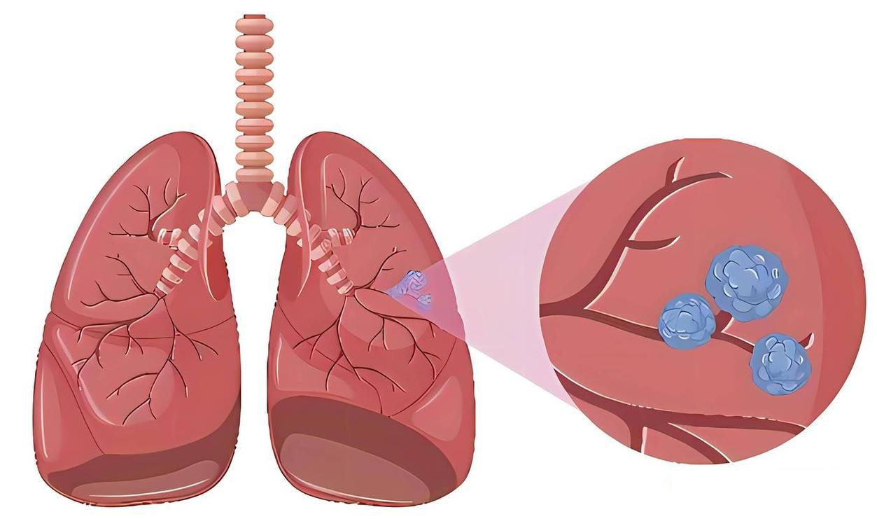 医生提醒：肺结节开始癌变时，身体或有3个标志，可别再拖了！