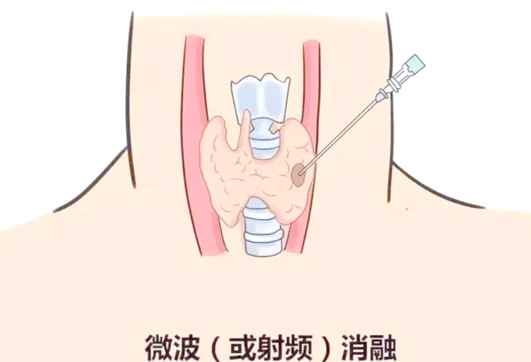 甲状腺结节别再盲目开刀！北京消融专家排行榜，微创治疗告别“颈”箍咒